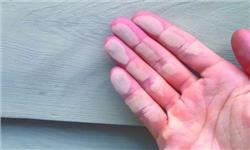 Hiện tượng phấn hóa nguyên nhân do đâu?