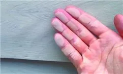 Hiện tượng phấn hóa nguyên nhân do đâu? Hiện tượng phấn hóa nguyên nhân do đâu?